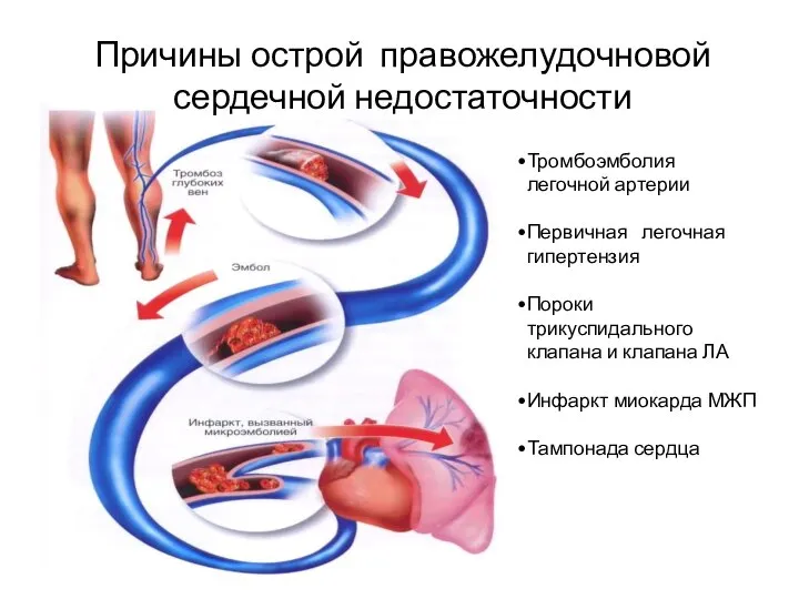 Тромбоэмболия легочной артерии Первичная легочная гипертензия Пороки трикуспидального клапана и клапана