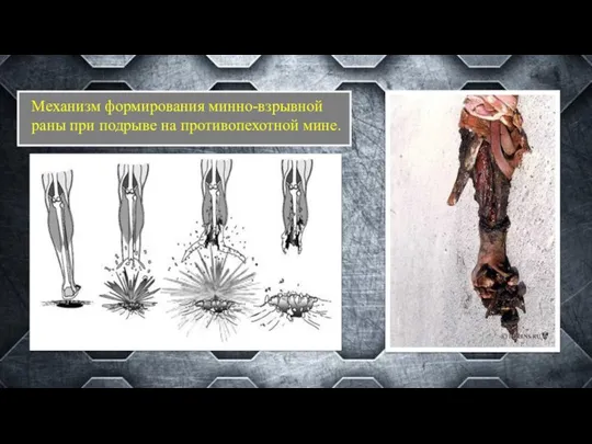 Механизм формирования минно-взрывной раны при подрыве на противопехотной мине.