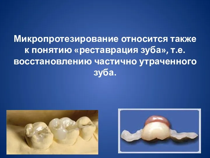 Микропротезирование относится также к понятию «реставрация зуба», т.е. восстановлению частично утраченного зуба.