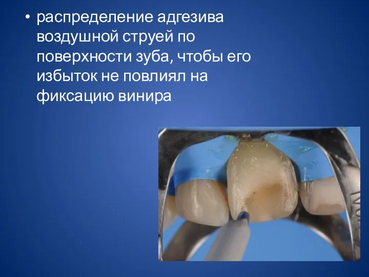 распределение адгезива воздушной струей по поверхности зуба, чтобы его избыток не повлиял на фиксацию винира