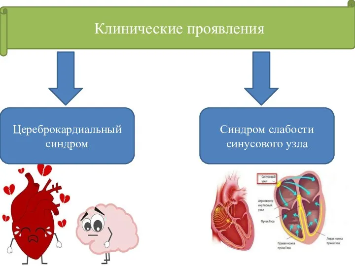 Клинические проявления Цереброкардиальный синдром Синдром слабости синусового узла