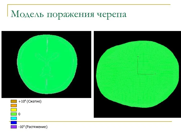 Модель поражения черепа +104 (Сжатие) 0 -104 (Растяжение)