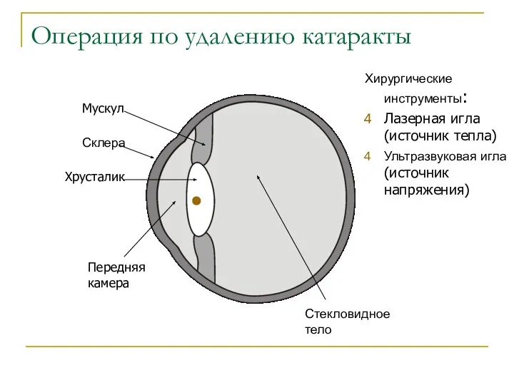 Операция по удалению катаракты Склера Стекловидное тело Мускул Хрусталик Передняя камера