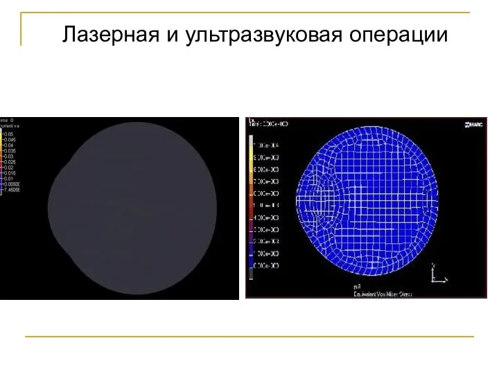 Лазерная и ультразвуковая операции