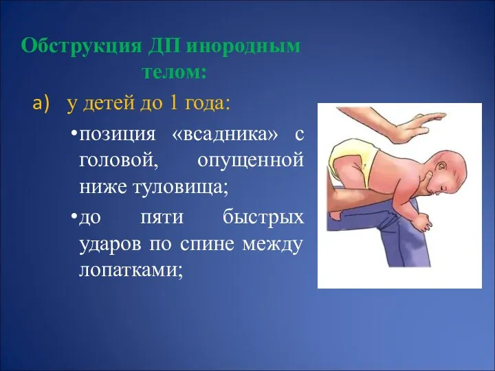 Обструкция ДП инородным телом: у детей до 1 года: позиция «всадника»