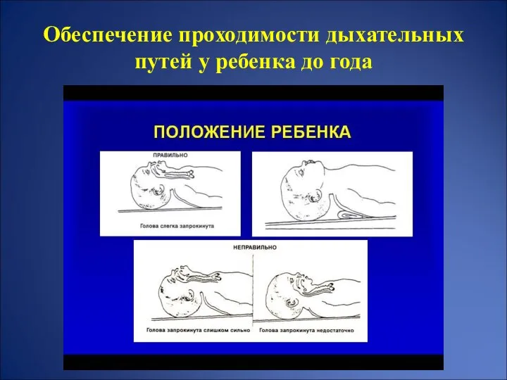 Обеспечение проходимости дыхательных путей у ребенка до года