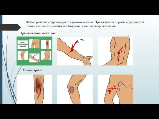 Любое ранение сопровождается кровотечением. При оказании первой медицинской помощи на месте