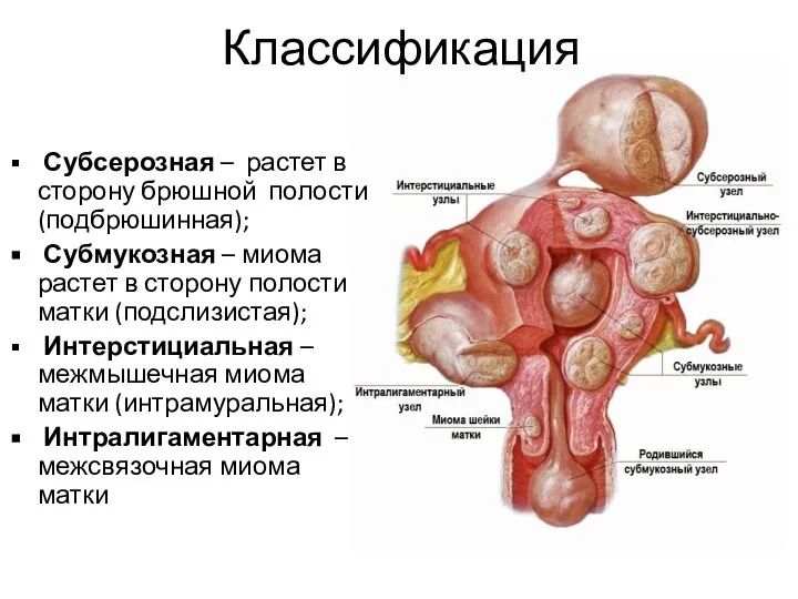 Классификация Субсерозная – растет в сторону брюшной полости (подбрюшинная); Субмукозная –