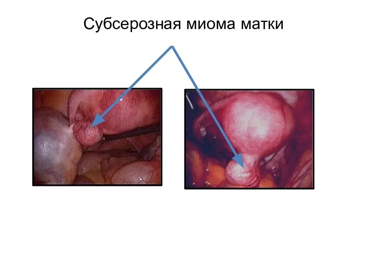 Субсерозная миома матки . .