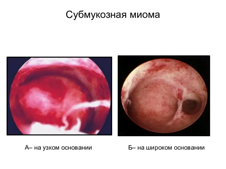 Субмукозная миома А– на узком основании Б– на широком основании
