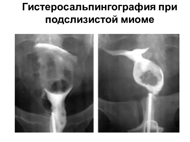 Гистеросальпингография при подслизистой миоме