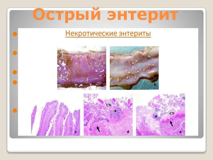 Острый энтерит Катаральный: слизистая и подслизистая оболочки пропитаны слизисто-серозным экссудатом. Фибринозный: