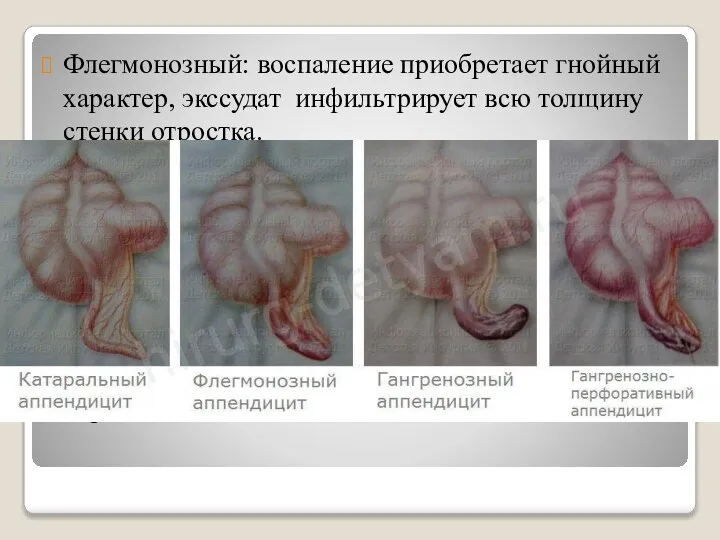 Флегмонозный: воспаление приобретает гнойный характер, экссудат инфильтрирует всю толщину стенки отростка.