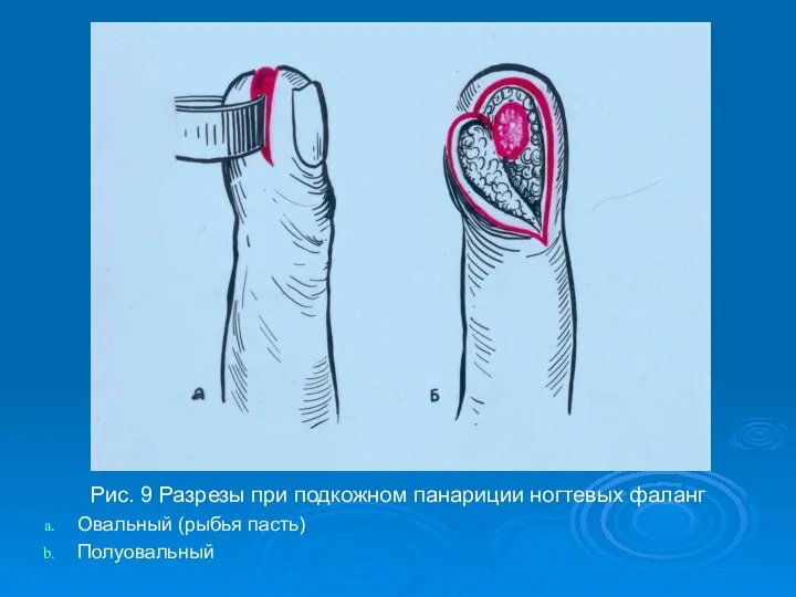 Рис. 9 Разрезы при подкожном панариции ногтевых фаланг Овальный (рыбья пасть) Полуовальный