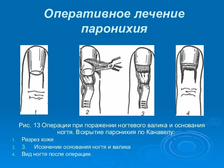 Рис. 13 Операции при поражении ногтевого валика и основания ногтя. Вскрытие
