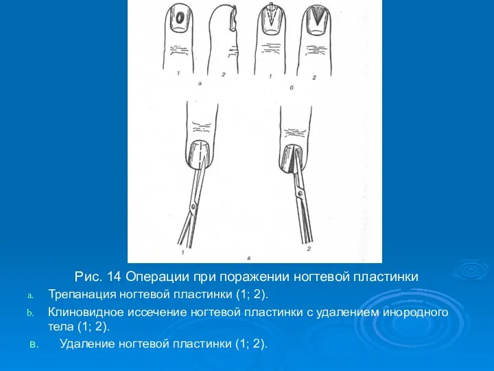 Рис. 14 Операции при поражении ногтевой пластинки Трепанация ногтевой пластинки (1;