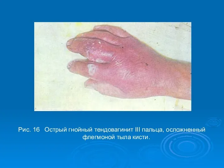 Рис. 16 Острый гнойный тендовагинит III пальца, осложненный флегмоной тыла кисти.
