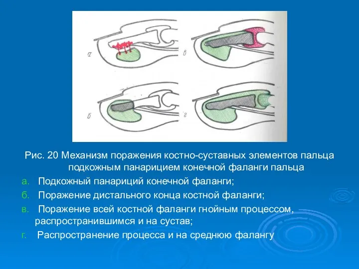 Рис. 20 Механизм поражения костно-суставных элементов пальца подкожным панарицием конечной фаланги