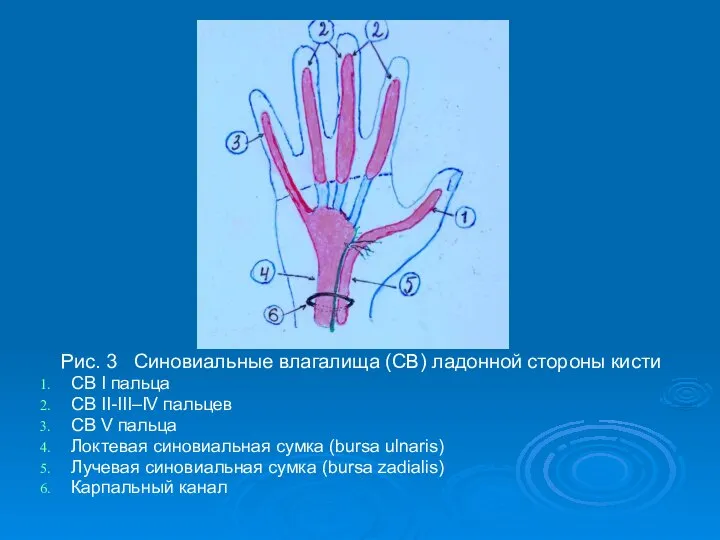 Рис. 3 Синовиальные влагалища (СВ) ладонной стороны кисти СВ I пальца