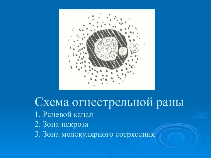 Схема огнестрельной раны 1. Раневой канал 2. Зона некроза 3. Зона молекулярного сотрясения