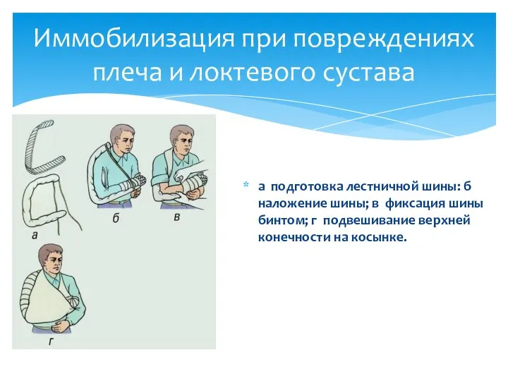 а подготовка лестничной шины: б наложение шины; в фиксация шины бинтом;