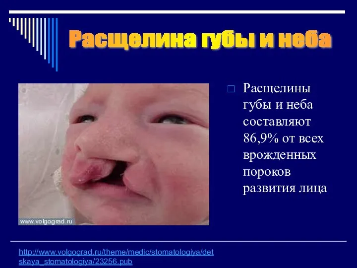 Расщелины губы и неба составляют 86,9% от всех врожденных пороков развития