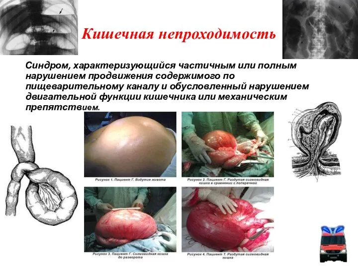 Кишечная непроходимость Синдром, характеризующийся частичным или полным нарушением продвижения содержимого по