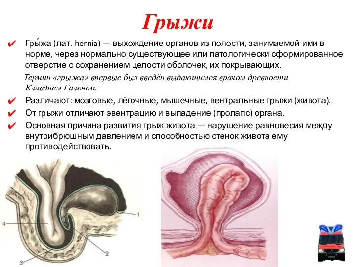 Гры́жа (лат. hernia) — выхождение органов из полости, занимаемой ими в