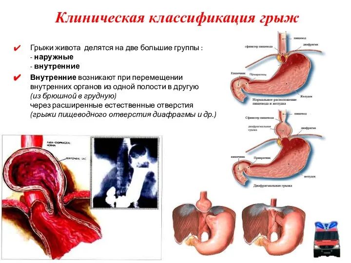 Грыжи живота делятся на две большие группы : - наружные -