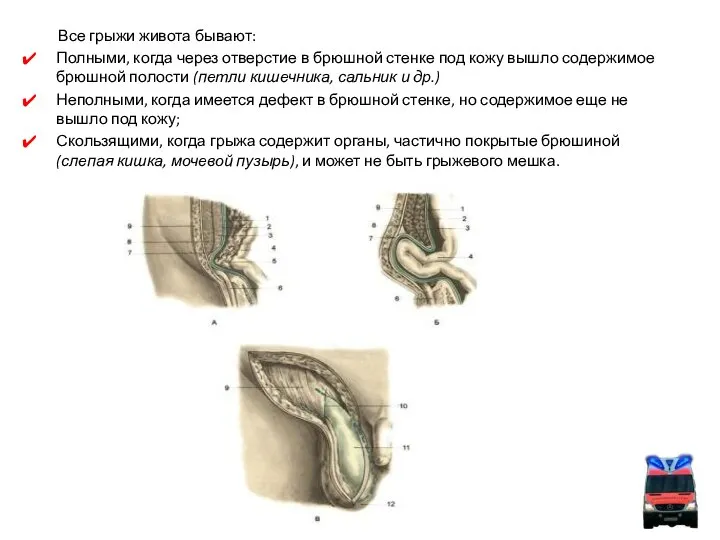 Все грыжи живота бывают: Полными, когда через отверстие в брюшной стенке