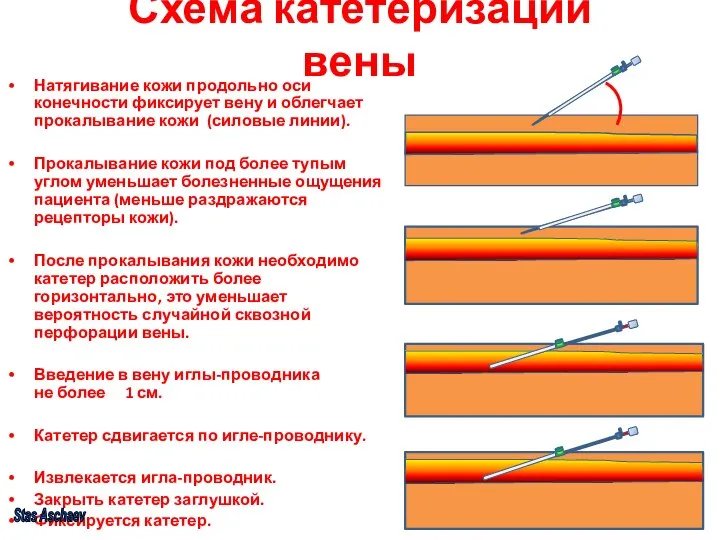 Схема катетеризации вены Натягивание кожи продольно оси конечности фиксирует вену и