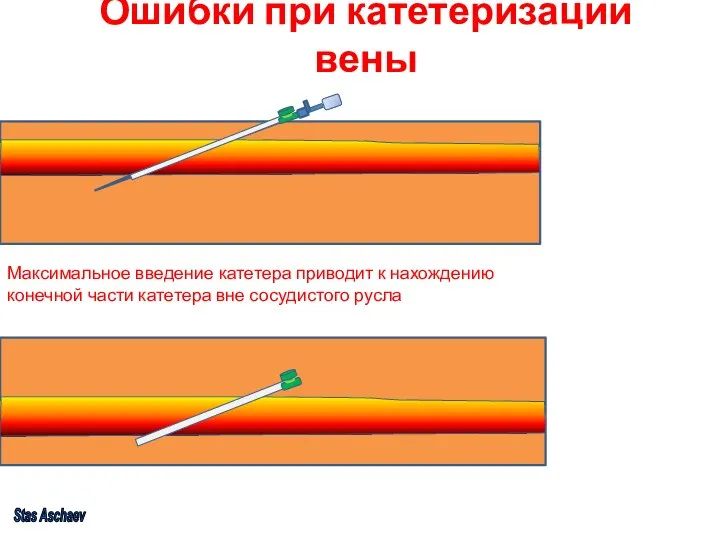 Ошибки при катетеризации вены Максимальное введение катетера приводит к нахождению конечной