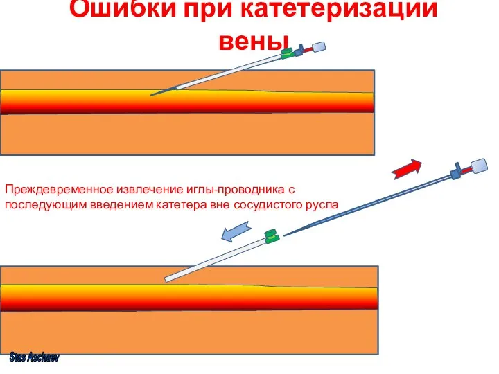 Ошибки при катетеризации вены Преждевременное извлечение иглы-проводника с последующим введением катетера вне сосудистого русла Stas Aschaev