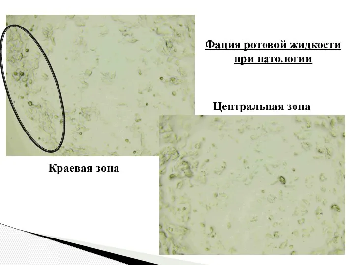 Центральная зона Краевая зона Фация ротовой жидкости при патологии