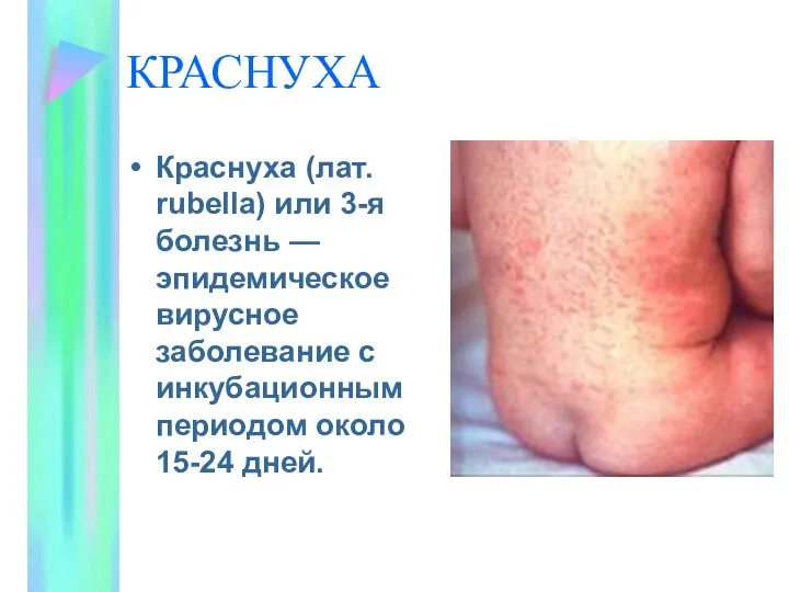 КРАСНУХА Краснуха (лат. rubella) или 3-я болезнь — эпидемическое вирусное заболевание