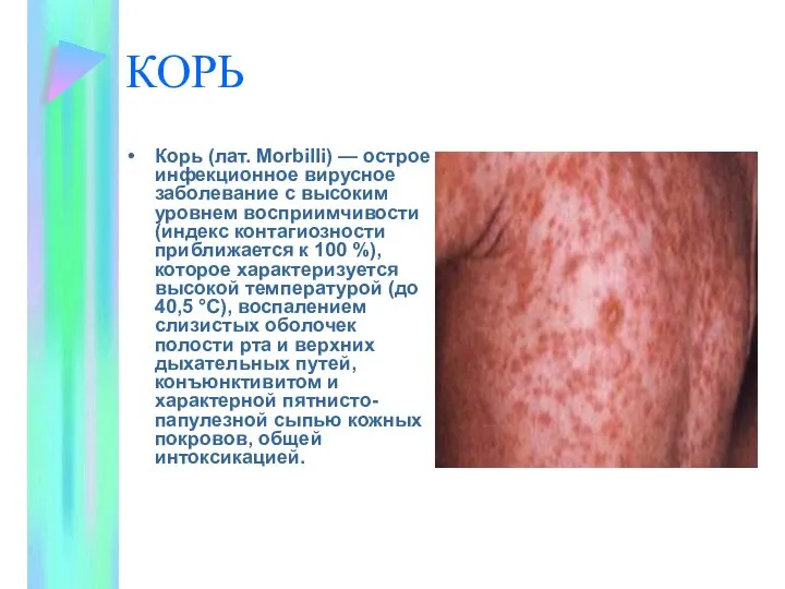 КОРЬ Корь (лат. Morbilli) — острое инфекционное вирусное заболевание с высоким