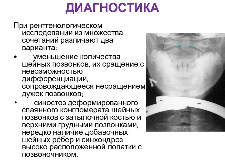 ДИАГНОСТИКА При рентгенологическом исследовании из множества сочетаний различают два варианта: •