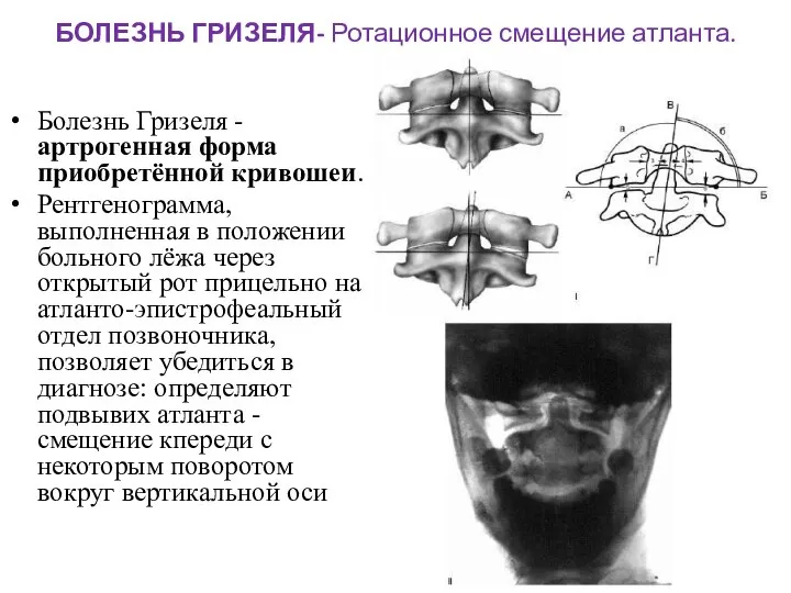 БОЛЕЗНЬ ГРИЗЕЛЯ- Ротационное смещение атланта. Болезнь Гризеля - артрогенная форма приобретённой