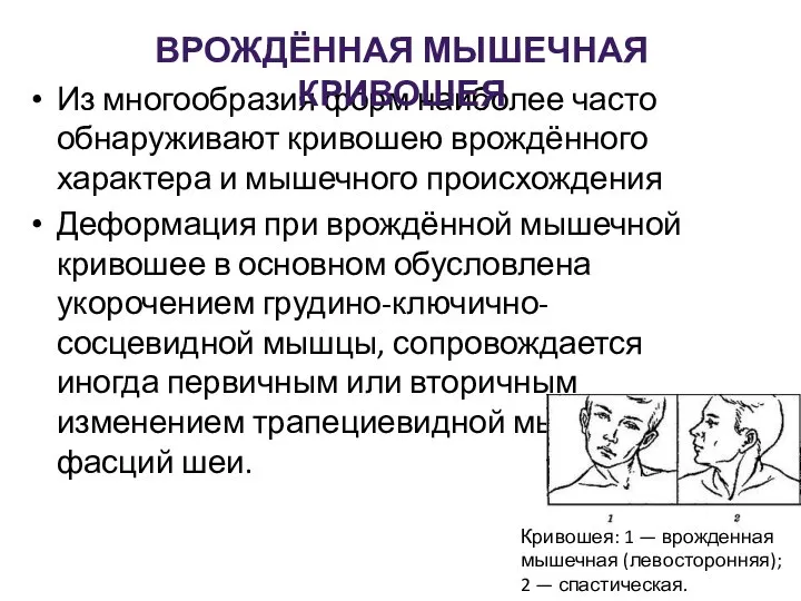 Из многообразия форм наиболее часто обнаруживают кривошею врождённого характера и мышечного