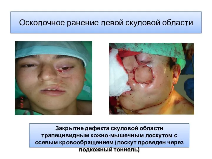 Осколочное ранение левой скуловой области Закрытие дефекта скуловой области трапецивидным кожно-мышечным