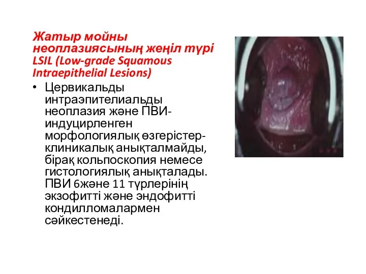 Жатыр мойны неоплазиясының жеңіл түрі LSIL (Low-grade Squamous Intraepithelial Lesions) Цервикальды