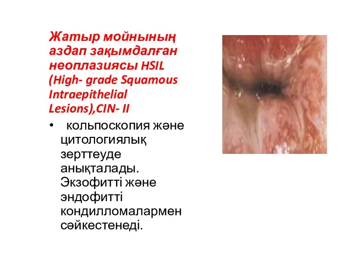 Жатыр мойнының аздап зақымдалған неоплазиясы HSIL (High- grade Squamous Intraepithelial Lesions),CIN-