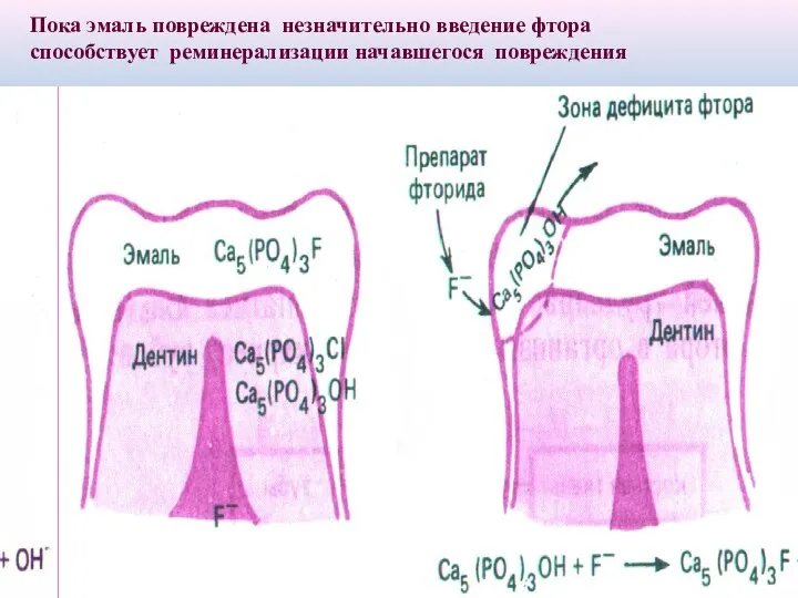 Пока эмаль повреждена незначительно введение фтора способствует реминерализации начавшегося повреждения