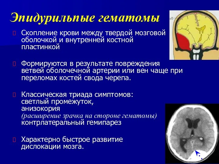 Эпидурильпые гематомы Скопление крови между твердой мозговой оболочкой и внутренней костной