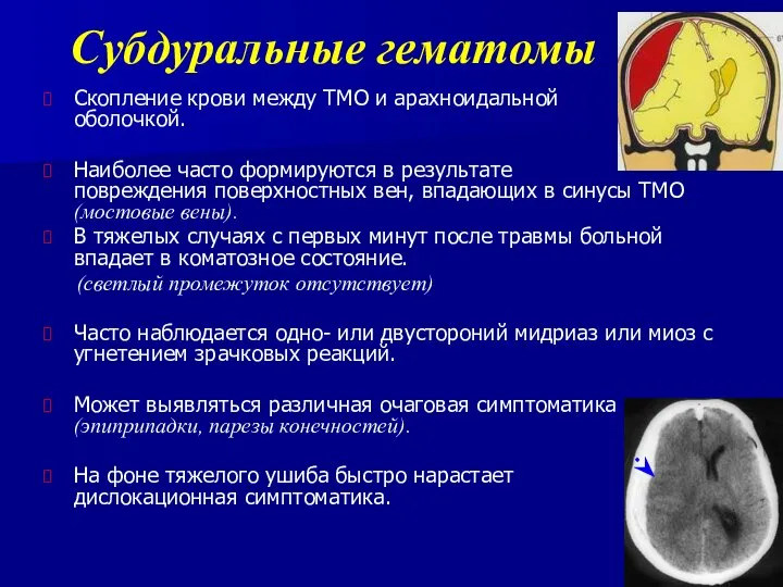 Субдуральные гематомы Скопление крови между ТМО и арахноидальной оболочкой. Наиболее часто