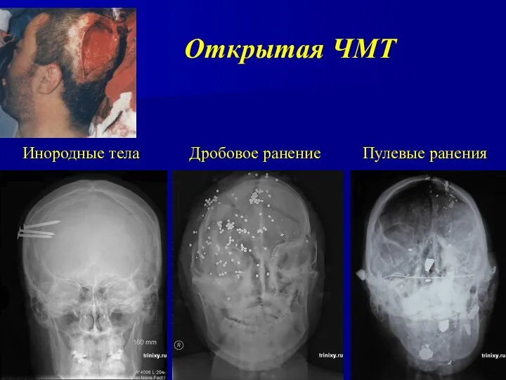 Открытая ЧМТ Дробовое ранение Инородные тела Пулевые ранения