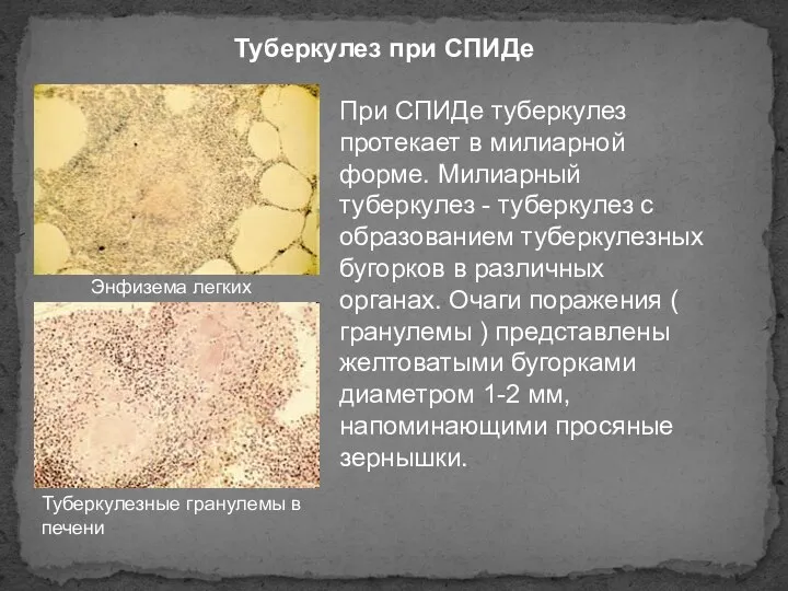 Туберкулез при СПИДе При СПИДе туберкулез протекает в милиарной форме. Милиарный