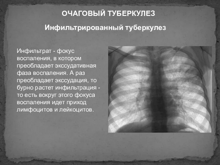 Инфильтрированный туберкулез ОЧАГОВЫЙ ТУБЕРКУЛЕЗ Инфильтрат - фокус воспаления, в котором преобладает