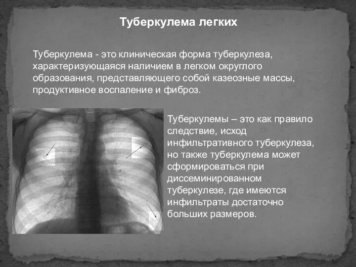 Туберкулема легких Туберкулема - это клиническая форма туберкулеза, характеризующаяся наличием в