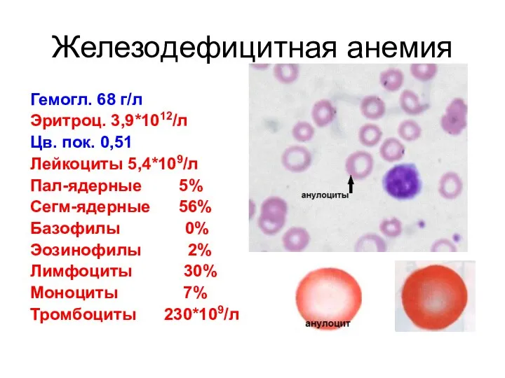 Железодефицитная анемия Гемогл. 68 г/л Эритроц. 3,9*1012/л Цв. пок. 0,51 Лейкоциты